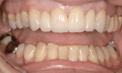 Smile following cosmetic enhancements