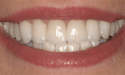 Bright white teeth following cosmetic treatment