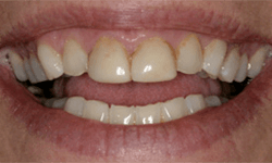 Teeth with deep yellow staining at gums