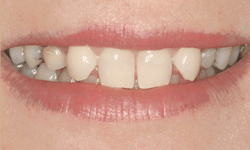 Teeth with gaps and discoloration