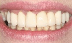 Flawlessly repaired smile following treatment