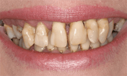Severely discolored and misshapen teeth