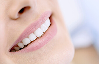 Closeup of smile with dental crown restorations