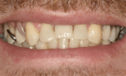 Uneven teeth with noticeable partial denture