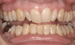 Crooked and yellowed teeth