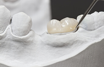 Model of smile with dental crown restoration