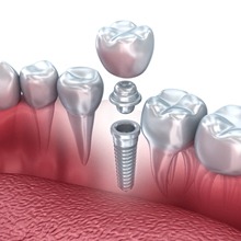 Model showing parts of a dental implant