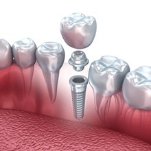 Model showing parts of a dental implant