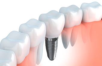 Diagram of an integrated dental implant in Houston