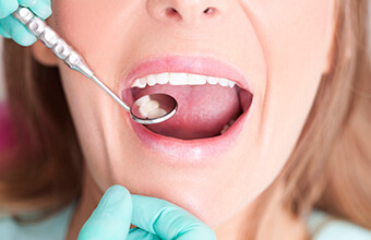 Smile examined with dental mirror after filling placement
