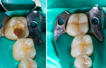 before and after tooth colored filling