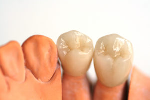 tooth colored permanent dental crowns