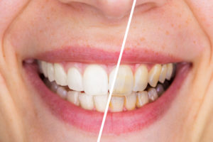 woman smiling before and after whitening