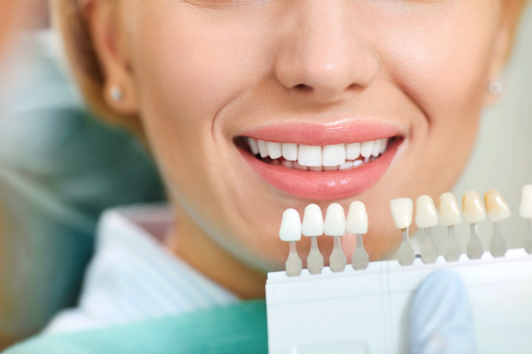 Benefits of Teeth Whitening Houston Dentist in Houston Cher Rich, DDS