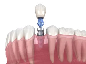 Image of a single dental implant