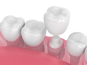 A digital image of a dental crown