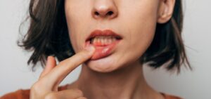 Woman pulling lip down to reveal red gums.